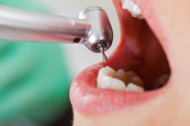 Best Emergency Wisdom Teeth Removal in Blakely, GA